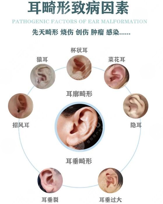 顱耳角在30°-60°之間朵形成原因