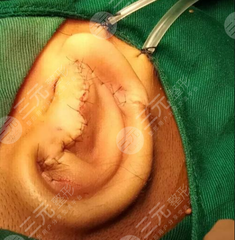 郭樹(shù)忠再造耳費(fèi)用