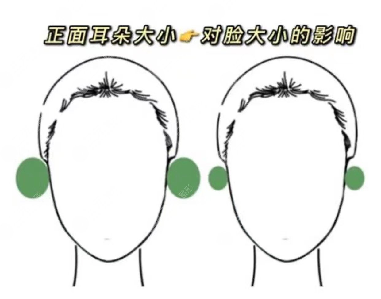 貼發(fā)耳矯正手術(shù)大概多少錢