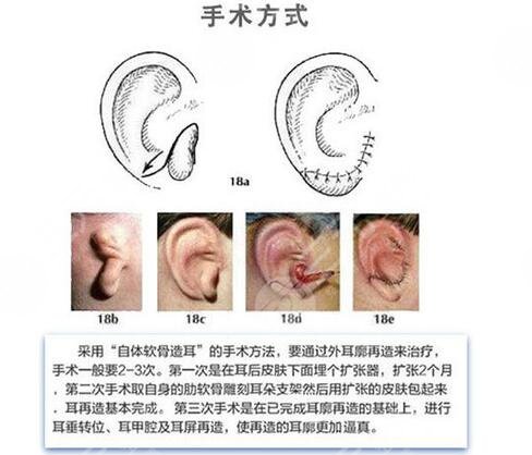 耳再造手術(shù)費(fèi)用