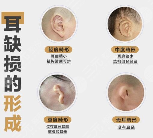 耳再造手術(shù)適合時(shí)間