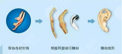 耳再造流程