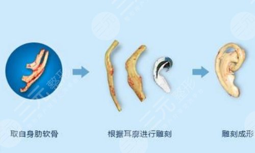 耳再造手術(shù)的優(yōu)勢