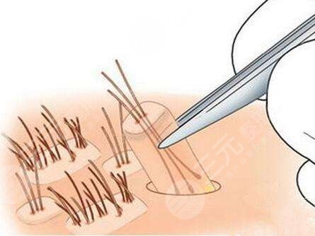 頭發(fā)種植術(shù)靠譜嗎