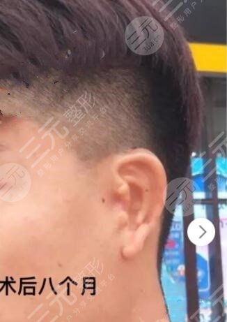 耳再造手術后