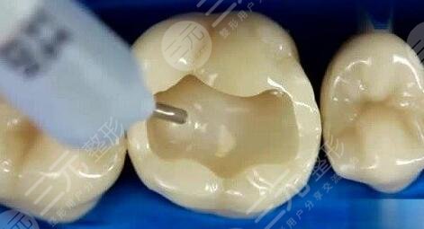 牙齒缺損的修復方法