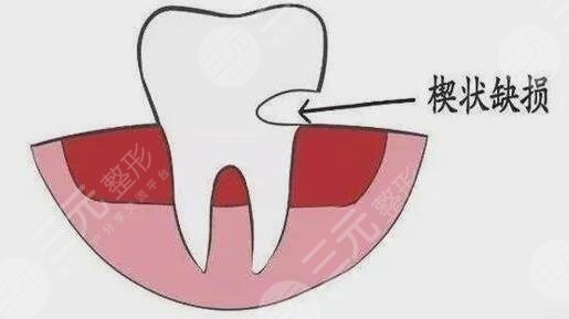 牙齒缺損的修復方法