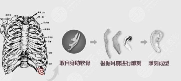 耳再造全包手術(shù)的原理