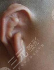 耳再造手術(shù)前