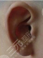 耳再造手術(shù)后