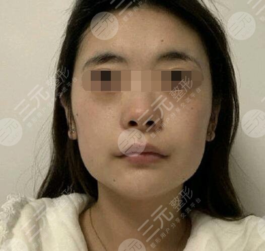 注射瘦臉的具體操作步驟是怎樣的