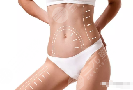 現(xiàn)在吸脂哪種技術(shù)好