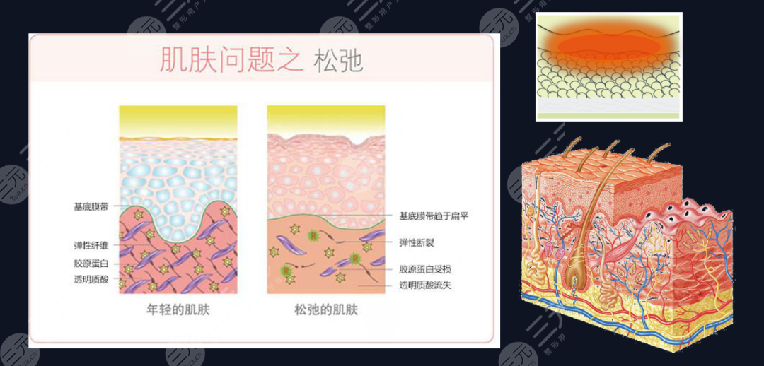 5d膠原光術后護理