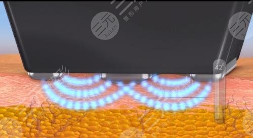 鉆石超塑爆脂費(fèi)用