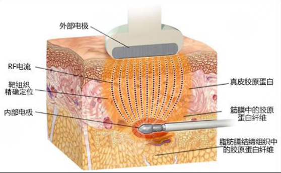 超脂塑溶脂的原理