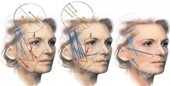面部抗衰抗皺知識科普