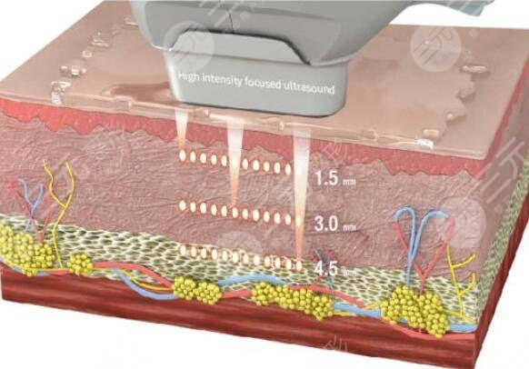 3d射頻緊膚去皺手術(shù)的原理