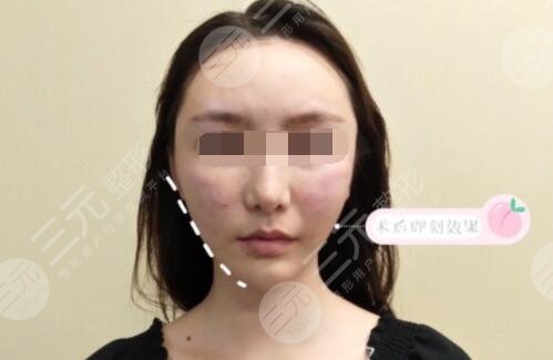 3d射頻緊膚去皺后果