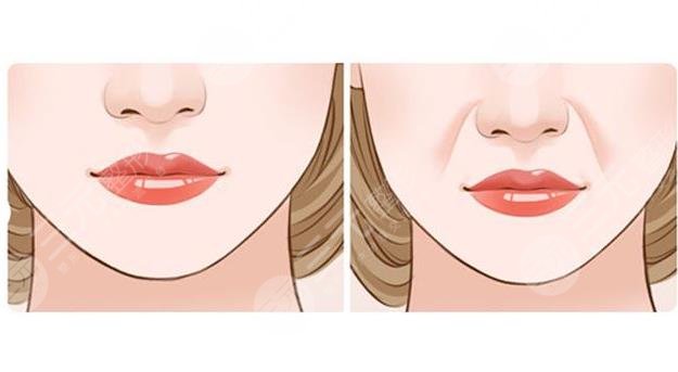 法令紋填充有后遺癥嗎