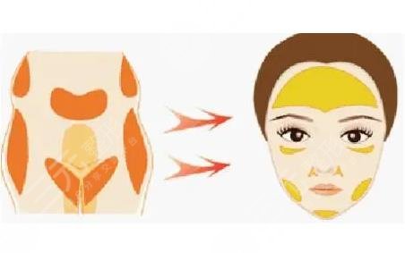 脂肪填充臉部需要多少錢