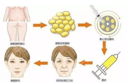 脂肪填充多久能恢復(fù)？填充臉部需要多少錢？附價(jià)格表+相關(guān)介紹