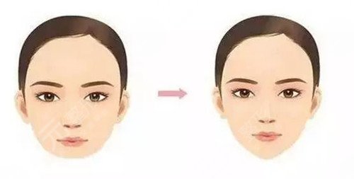 脂肪填充面部的原理