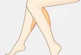 吸脂瘦腿相關(guān)科普介紹