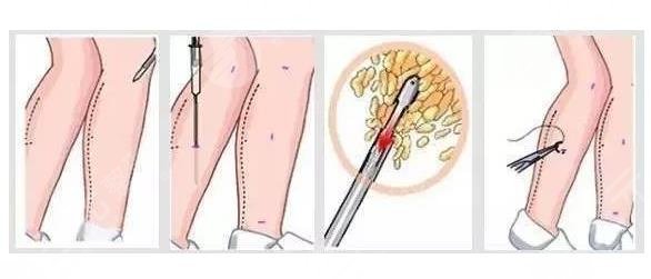 吸脂瘦腿相關(guān)科普介紹
