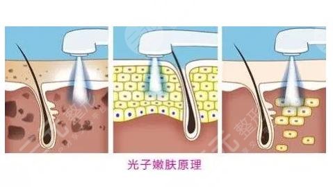 光子嫩膚后注意事項(xiàng)有哪些