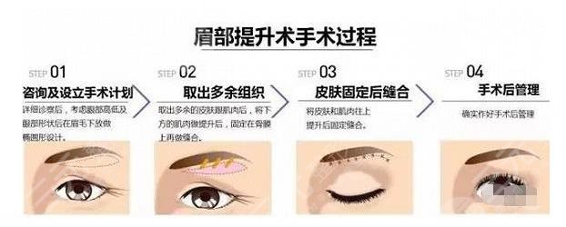 眼皮松弛怎么辦