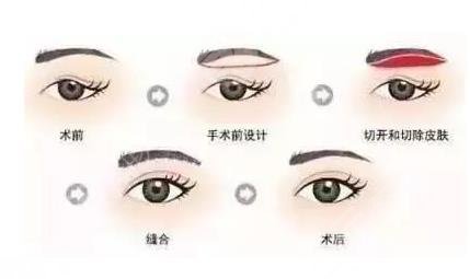 眼皮松弛怎么辦