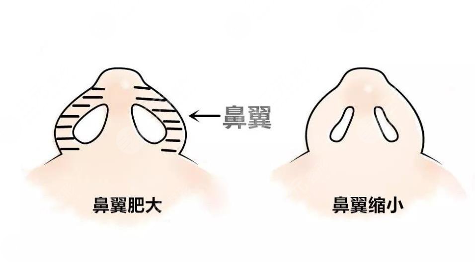 鼻翼太寬怎么整形？鼻翼縮小手術(shù)怎么樣？附鼻部整形價格表