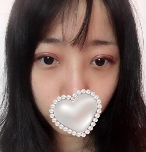 三點定位雙眼皮果圖分享