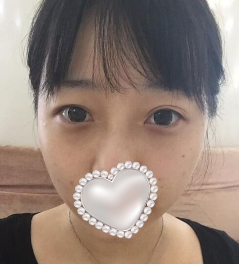 三點定位雙眼皮果圖分享