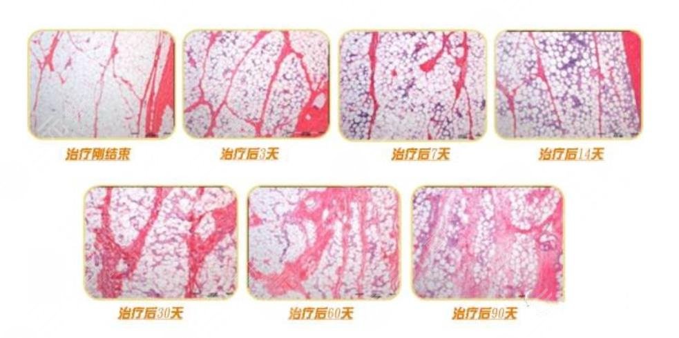 超脂塑塑型果維持時(shí)間久嗎?