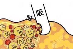 超脂塑是什么？與傳統(tǒng)吸脂有什么優(yōu)勢(shì)？纖細(xì)身材get？