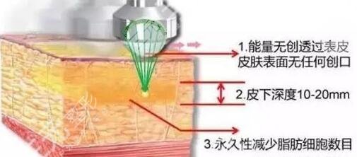 超脂塑術后恢復期是多久?