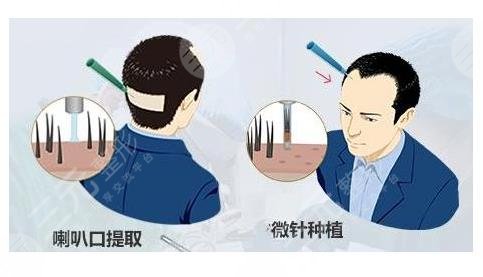 植發(fā)相關(guān)問(wèn)答科普介紹