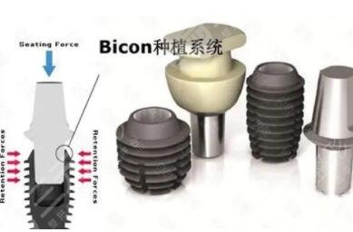 美國(guó)百康種植牙