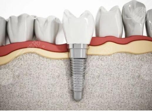 法國(guó)安卓健種植體