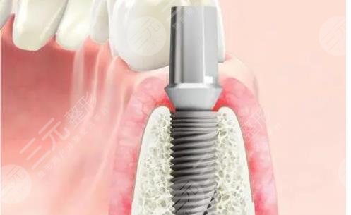 瑞士iti種植牙多少錢一顆