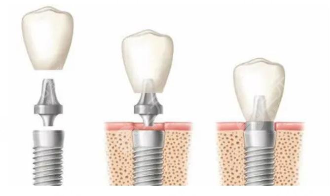 瑞士iti種植牙多少錢一顆