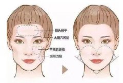 面部填充需要多少錢？2021價格攻略來襲！附真人案例，驚艷種草！