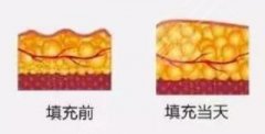 夏天做脂肪填充好不好，有利于恢復(fù)嗎？面填指南！分享果圖&價格！