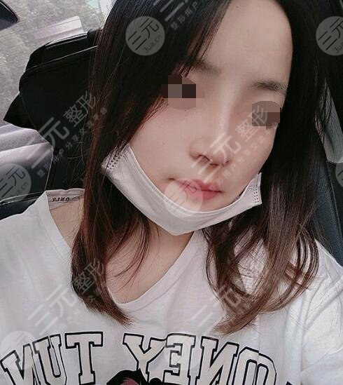 假體隆鼻術(shù)后2個(gè)月