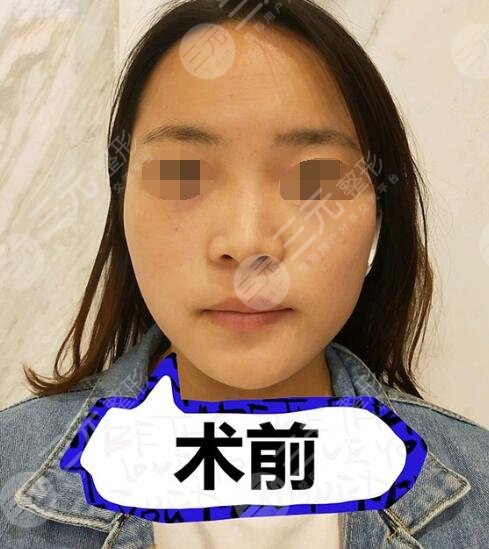 假體隆鼻術(shù)前