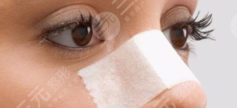 做假體隆鼻術(shù)后怎么護(hù)理