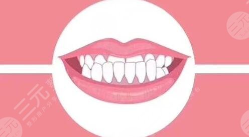 地包天手術(shù)整形費(fèi)用多少錢？地包天矯正案例：收獲標(biāo)準(zhǔn)臉型！