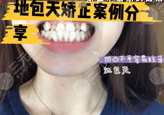 地包天手術(shù)整形費(fèi)用多少錢術(shù)前