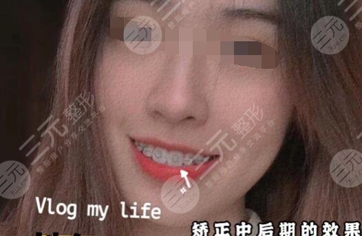 地包天手術(shù)整形費(fèi)用多少錢術(shù)后3個(gè)月